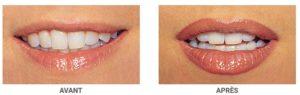 Résultat de la dermopigmentation des lèvres